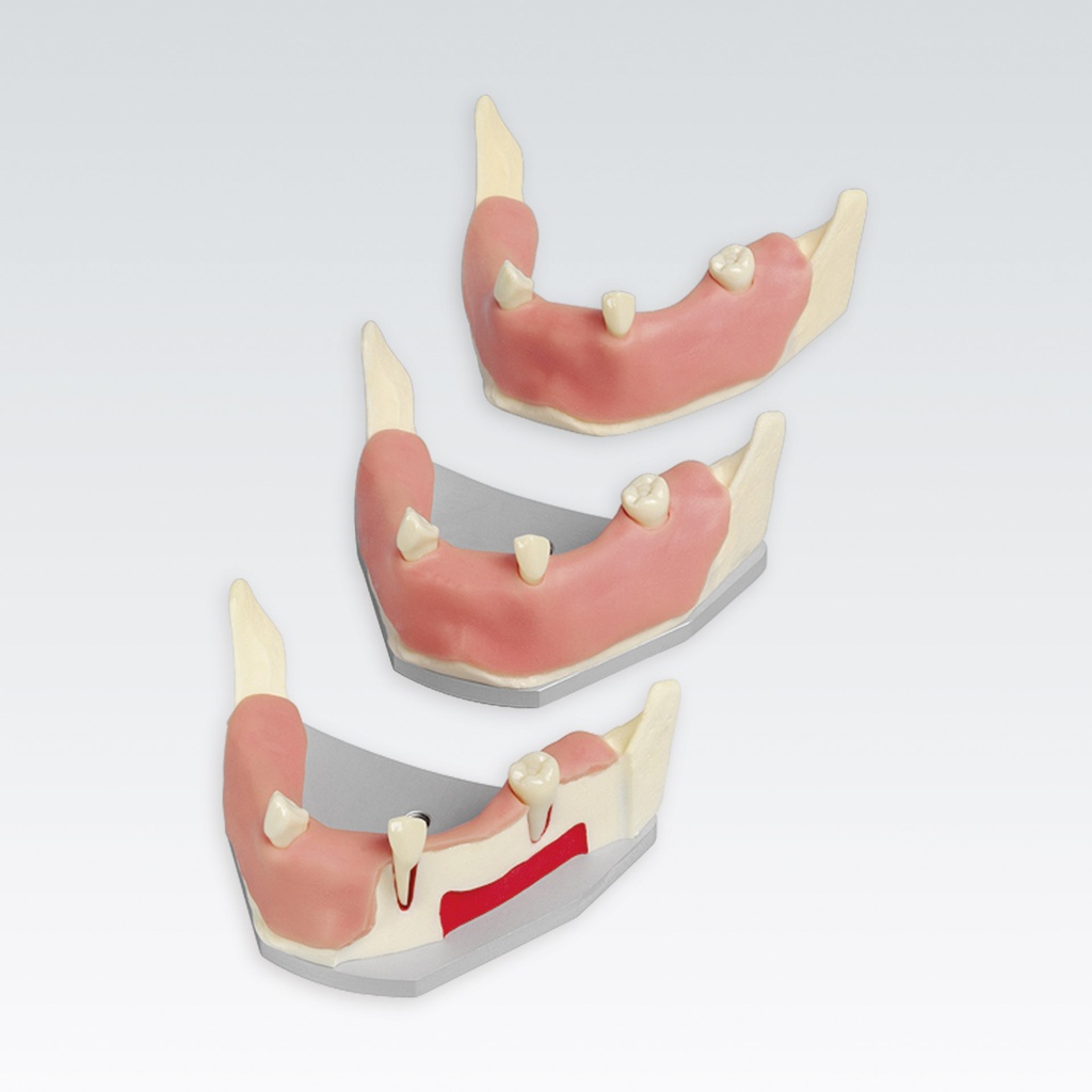 Frasaco mandibule pour implantologie avec gencive – réf. A-J F UKW
